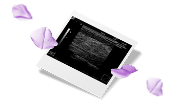 УЗИ молочных желёз